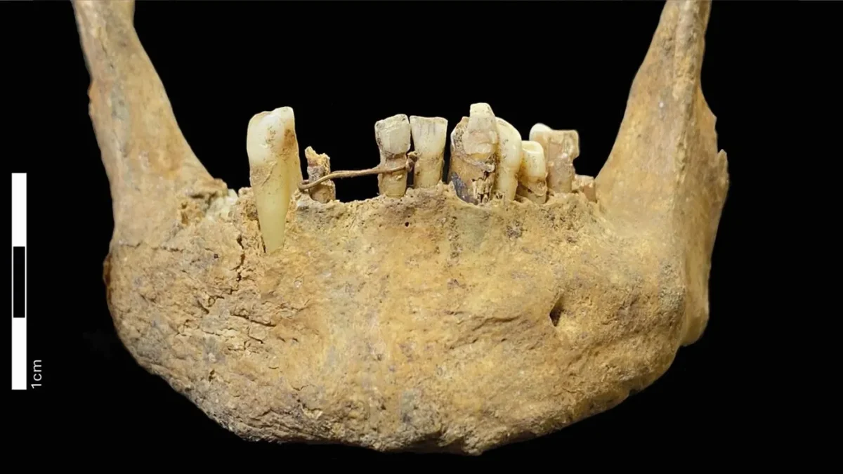 A mais antiga ponte dentária escocesa: fio de ouro de 500 anos em mandíbula de igreja medieval