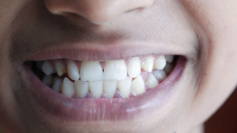 Adeus à sensibilidade? Novo gel consegue reconstruir parte do esmalte dos dentes em testes científicos