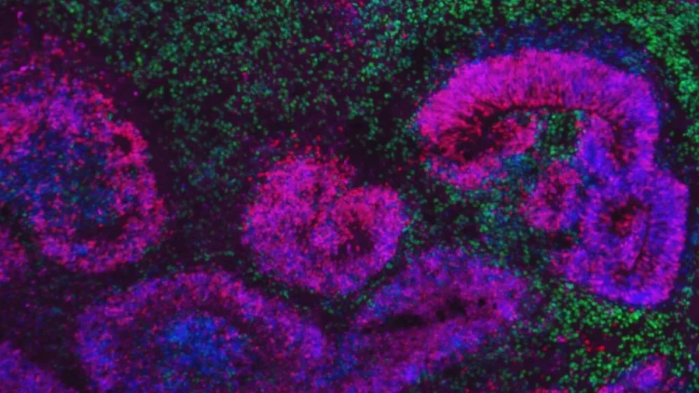 O maior estudo sobre o desenvolvimento cerebral traz pistas inéditas sobre a esquizofrenia