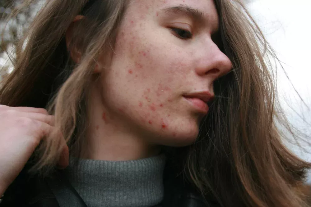 5 conselhos de dermatologistas para adolescentes cuidarem da pele sem exagerar